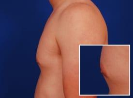 Gynecomastia Surgery Before & After Image