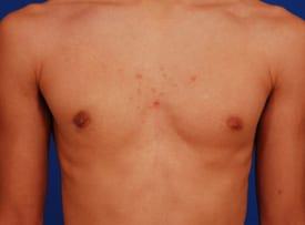 Gynecomastia Surgery Before & After Image