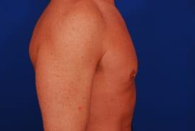 Gynecomastia Surgery Before & After Image