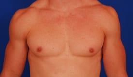 Gynecomastia Surgery Before & After Image