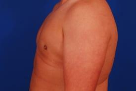 Gynecomastia Surgery Before & After Image