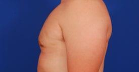 Gynecomastia Surgery Before & After Image