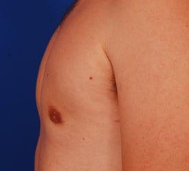 Gynecomastia Surgery Before & After Image