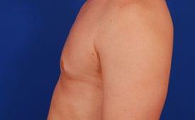 Gynecomastia Surgery Before & After Image