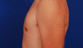 Gynecomastia Surgery Before & After Image