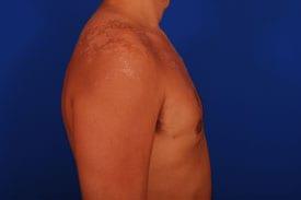 Gynecomastia Surgery Before & After Image