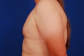 Gynecomastia Surgery Before & After Image