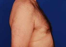 Gynecomastia Surgery Before & After Image