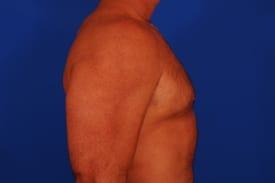 Gynecomastia Surgery Before & After Image