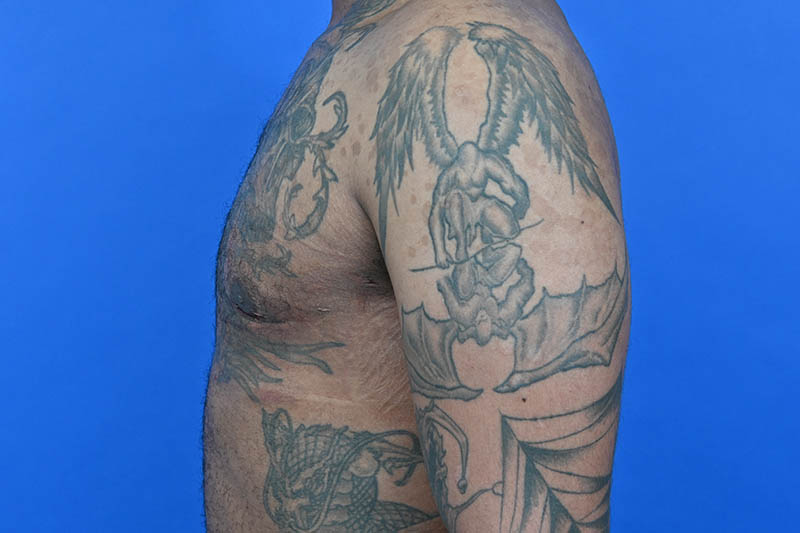 Revision Gynecomastia Surgery Before & After Image