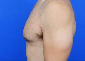 Revision Gynecomastia Surgery Before & After Image