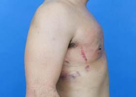 Revision Gynecomastia Surgery Before & After Image