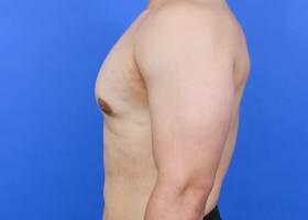 Revision Gynecomastia Surgery Before & After Image