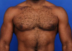 Austin Gynecomastia Surgery patient After