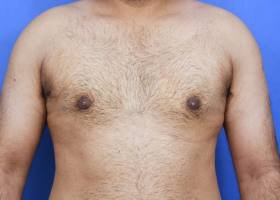 Austin Gynecomastia Surgery patient After
