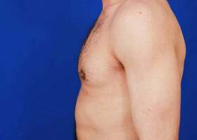 Austin Gynecomastia Surgery patient After