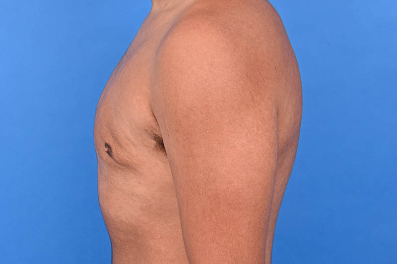 Gynecomastia Surgery Before & After Image
