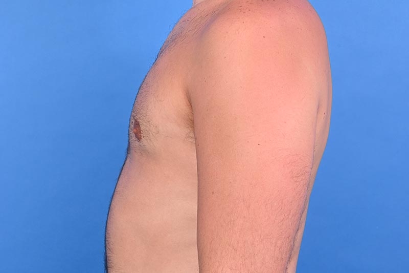 Gynecomastia Surgery Before & After Image