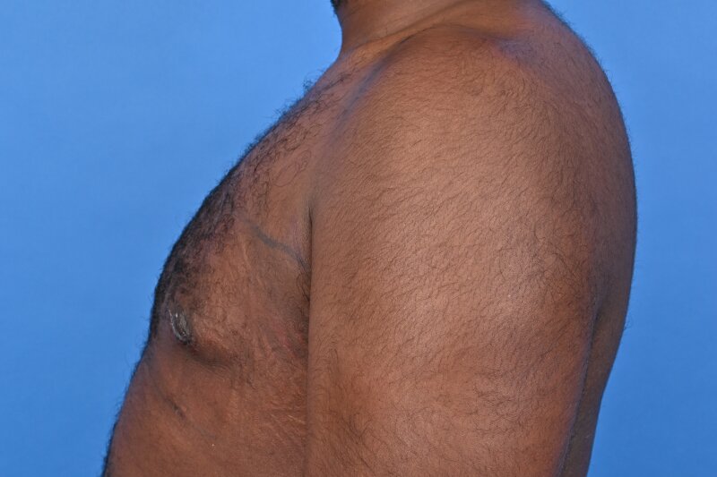 Gynecomastia Surgery Before & After Image