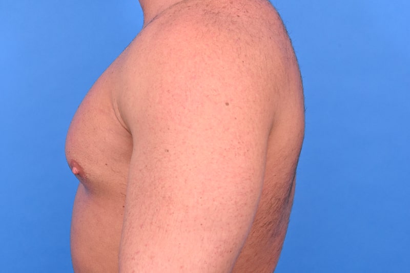 Gynecomastia Surgery Before & After Image