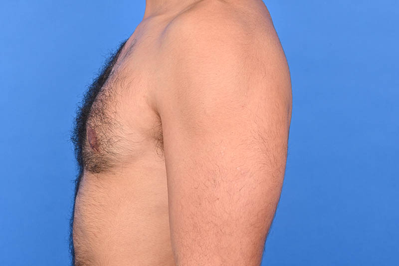 Gynecomastia Surgery Before & After Image