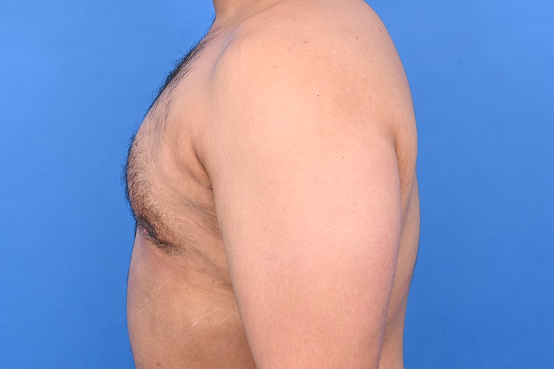 Gynecomastia Surgery Before & After Image