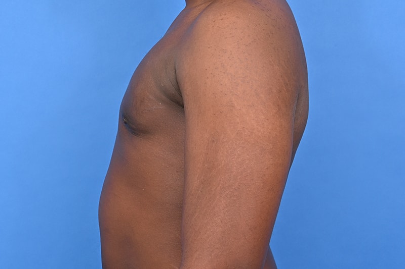 Gynecomastia Surgery Before & After Image