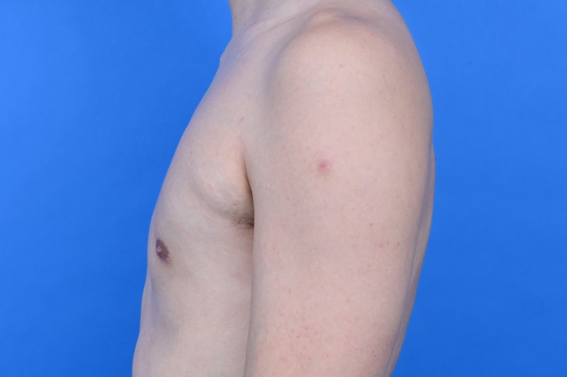 Gynecomastia Surgery Before & After Image