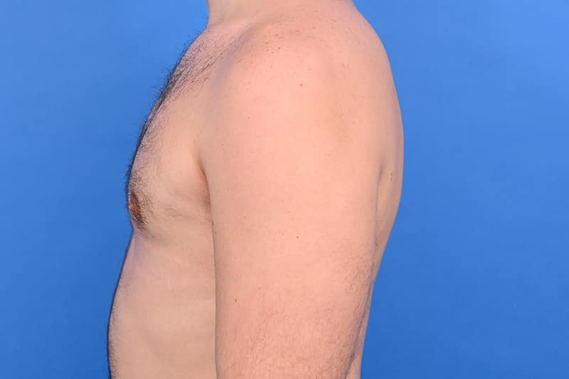 Gynecomastia Surgery Before & After Image