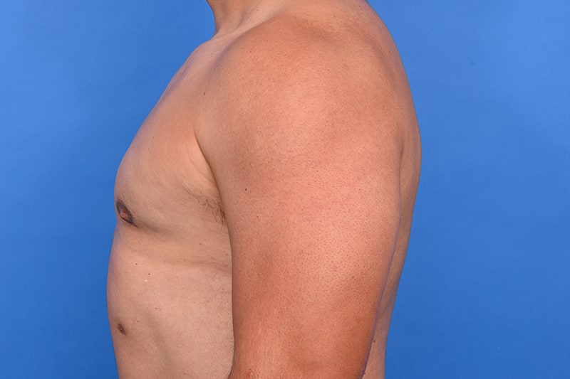 Gynecomastia Surgery Before & After Image