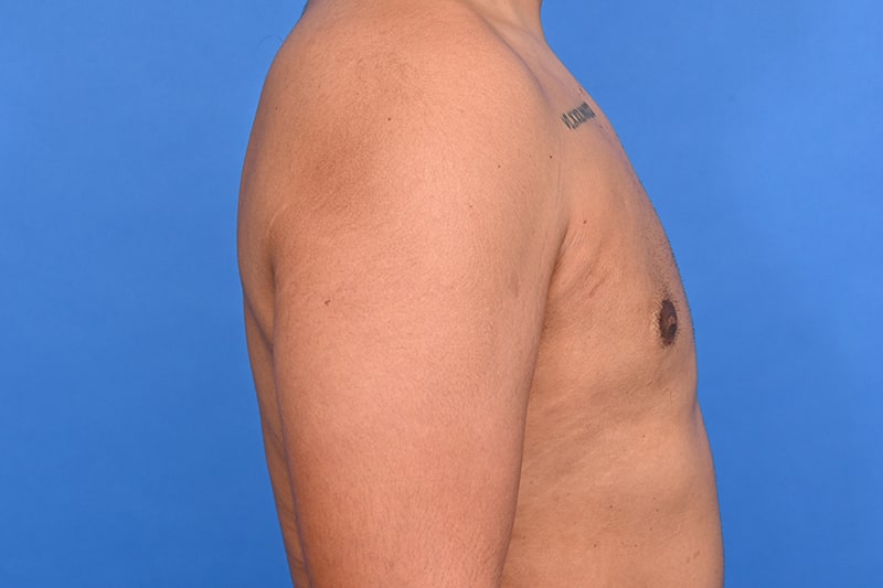 Gynecomastia Surgery Before & After Image