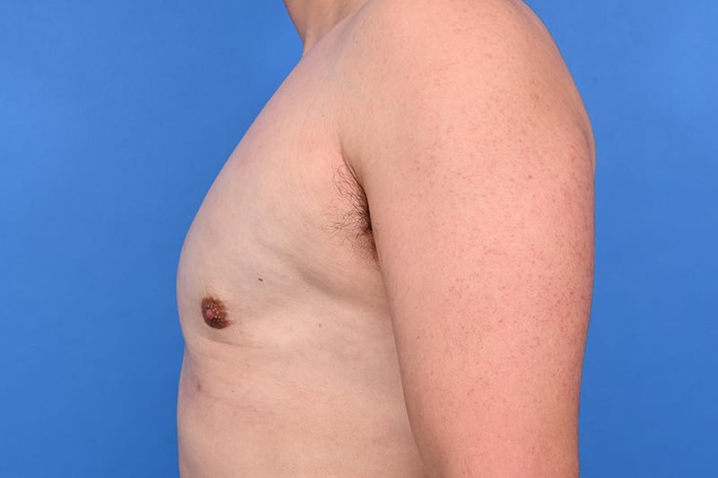 Gynecomastia Surgery Before & After Image