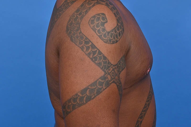 Gynecomastia Surgery Before & After Image