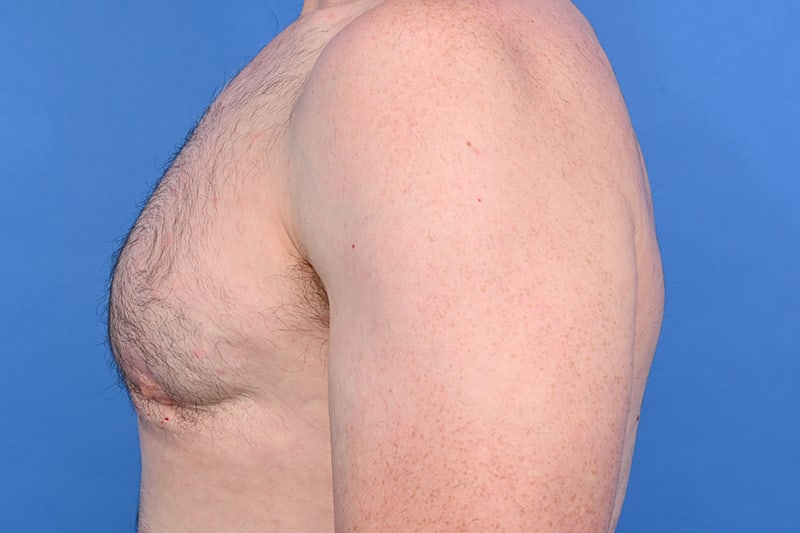 Gynecomastia Surgery Before & After Image