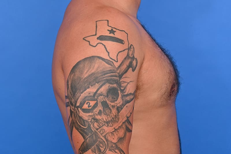 Gynecomastia Surgery Before & After Image