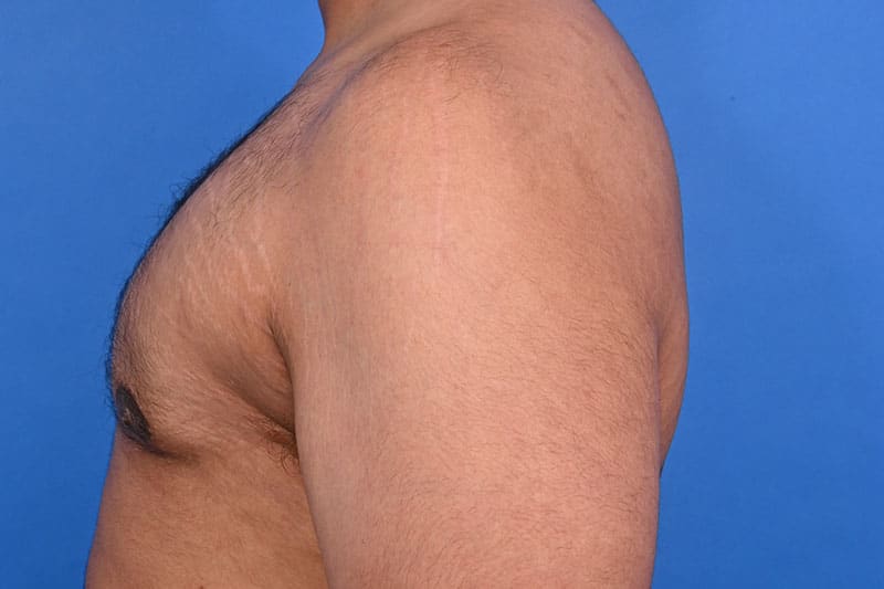 Gynecomastia Surgery Before & After Image