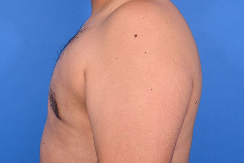 Gynecomastia Surgery Before & After Image
