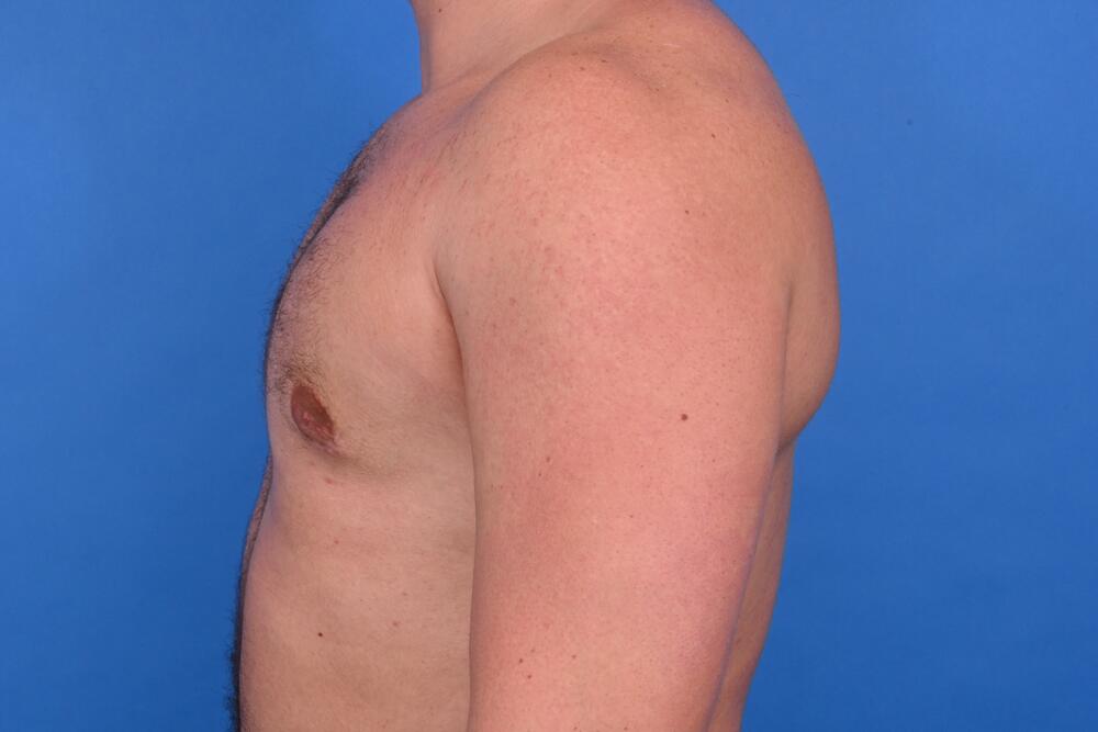 Gynecomastia Surgery Before & After Image