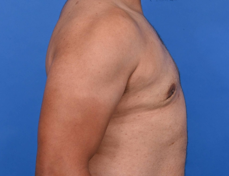Gynecomastia Surgery Before & After Image