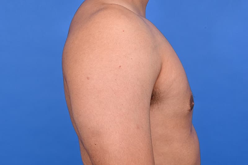 Gynecomastia Surgery Before & After Image