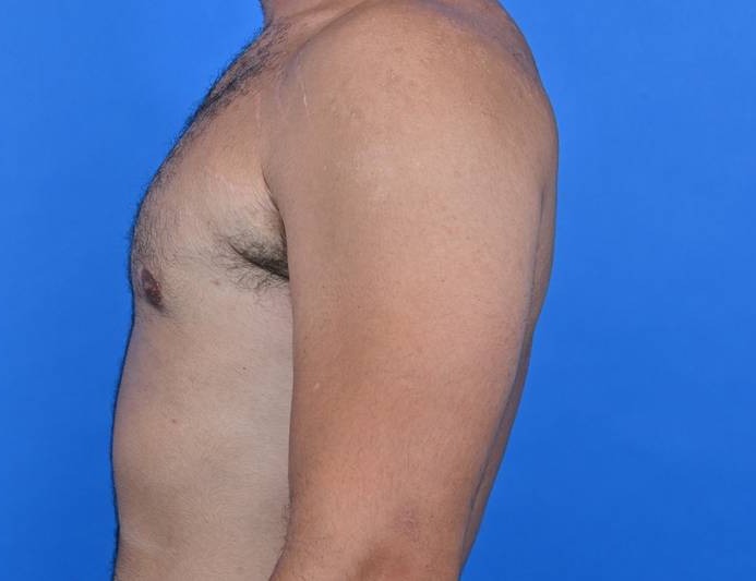 Gynecomastia Surgery Before & After Image