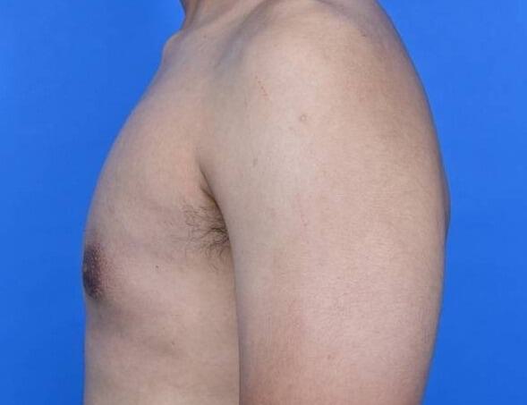 Gynecomastia Surgery Before & After Image