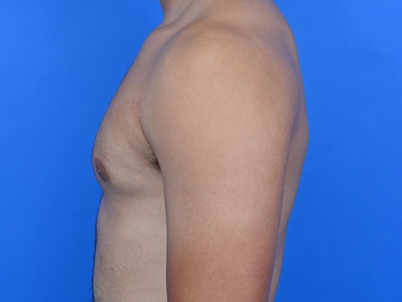 Gynecomastia Surgery Before & After Image