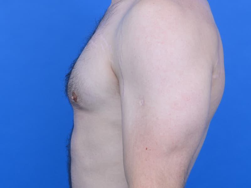Gynecomastia Surgery Before & After Image