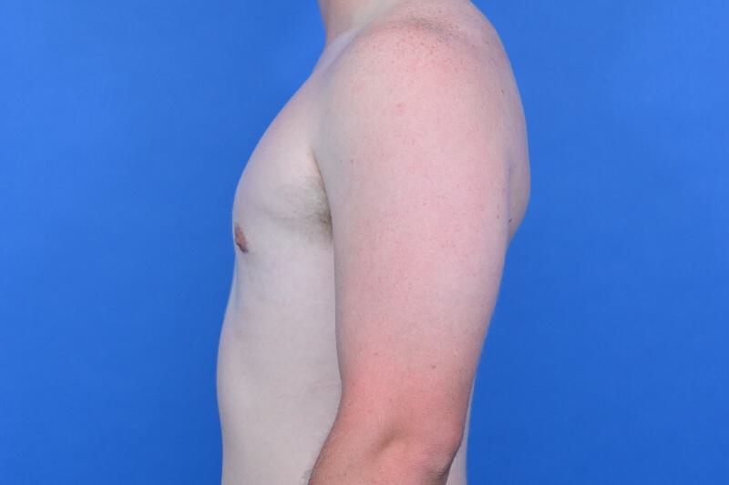 Gynecomastia Surgery Before & After Image