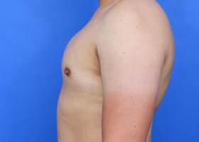 Gynecomastia Surgery Before & After Image