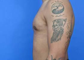 Gynecomastia Surgery Before & After Image