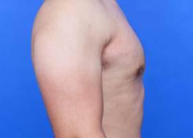 Gynecomastia Surgery Before & After Image