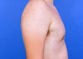 Gynecomastia Surgery Before & After Image