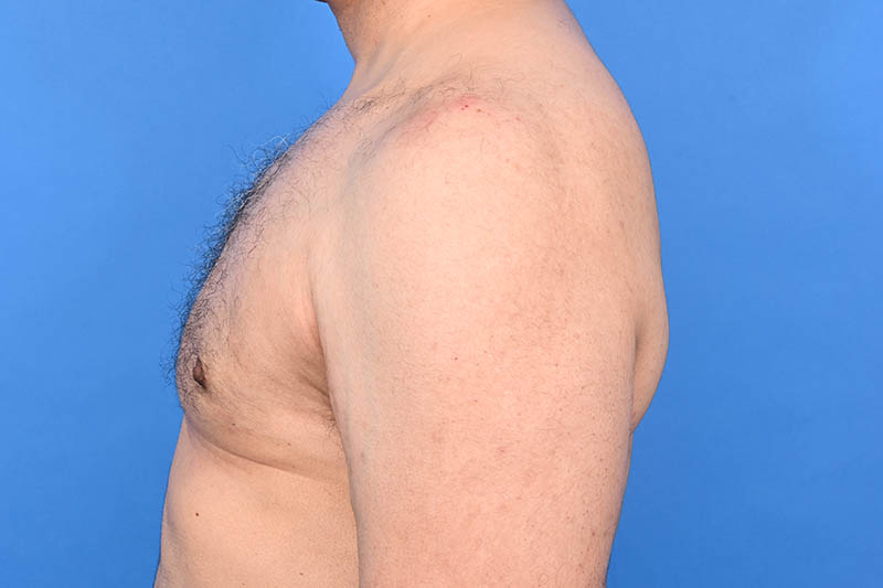 Gynecomastia Surgery Before & After Image